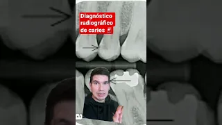 DIAGNÓSTICO RADIOGRÁFICO DE CARIES | Caries dental en radiografías