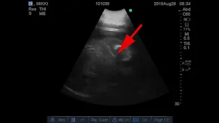 September 4, 2018 Mikki Ultrasound