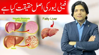 Fatty Liver ki Asal Haqiqat kya hy? || Dr Affan Qaiser