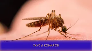 Укусы комаров