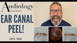 EAR WAX PEEL FROM EAR CANAL AND EARDRUM - EP506