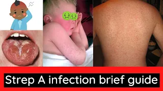 Strep A (Scarlet fever) infection information for patients.