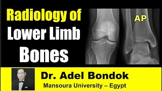 Radiological Anatomy of the Lower Limb Bones, Dr Adel Bondok