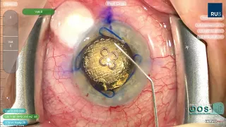 Femtosecond laser-assisted cataract surgery after trabeculectomy