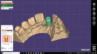 Exocad: Custom Abutment to Screw Retained