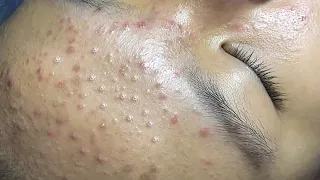 Satisfying Hien Spa Beauty Relaxing Video #33