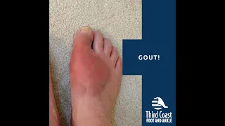 Gout | Third Coast Foot and Ankle