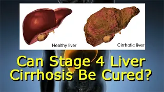 Can Stage 4 Liver Cirrhosis Be Cured?