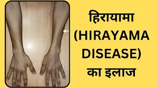 Hirayama  Disease