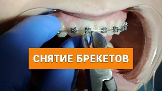 Снятие брекетов – самый счастливый и долгожданный день для пациентов