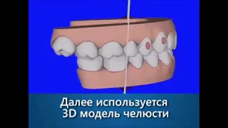 Инвизилайн - лечение без брекетов часть 2