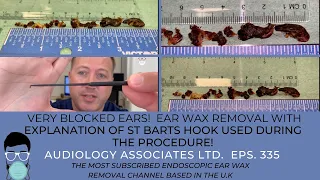 VERY BLOCKED EARS!  - EAR WAX REMOVAL AND EXPLANATION OF ST BARTS HOOK - EP 335