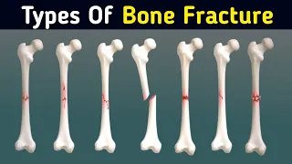 Common Types of bone Fractures 3d Animation|Wahab'sBiology