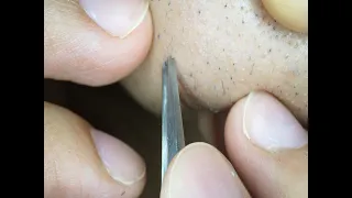 Extractions Ingrown Hair l Tweezers Beard l Finishing 2020/6/23