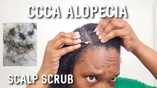CCCA Alopecia Hair & Scalp Care | Scalp Scrub & Update #alopecia