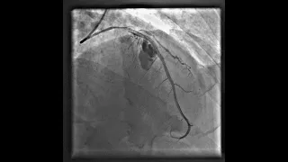 coronary perforation, primary pci