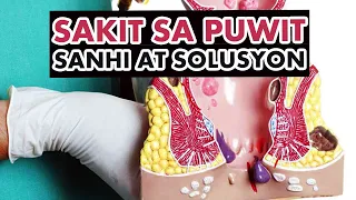 Hemorrhoids or Almoranas: Sakit sa Puwit Sanhi at Solusyon | Sagot Ka Ni Dok