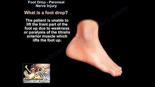 Foot Drop Peroneal Nerve Injury - Everything You Need To Know - Dr. Nabil Ebraheim