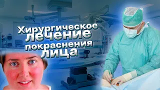 Хирургическое лечение блашинг-синдрома, покраснение лица и шеи