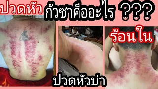 EP.28 กัวซาคืออะไร??ปวดหัว,ปวดบ่า,คั้นเนื้อคันตัวเป็นไข้,ร้อนใน, หายจริงหรือ ในคลิปมีคำตอบ