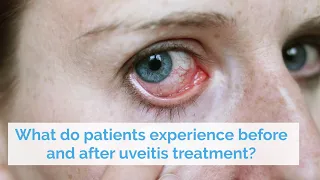 What do patients experience before and after uveitis treatment?