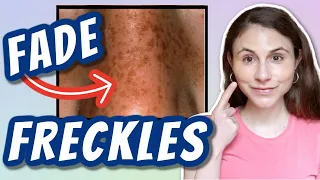 HOW TO FADE FRECKLES| Dr Dray