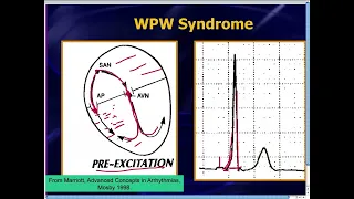 Amal Mattu's ECG Case of the Week_ Nov 18, 2013