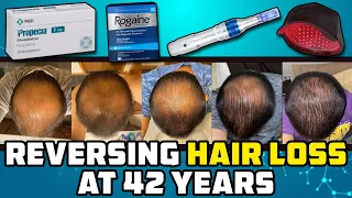 He Let Himself Go Bald, Then At 42 He Tried Reversing It And This Is What Happened...