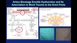 Penile Revascularization Surgery for ED - Penile Fracture and Artery Blockage ED: Video #8