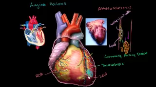 Heart Disease and Heart Attacks