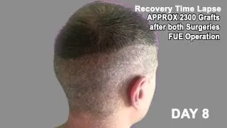 Hair Transplant Review 2013 19 DAY RECOVERY TIME LAPSE OF DONOR AREA POST OP