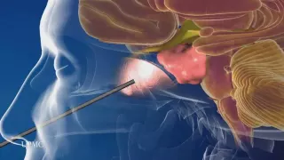 Minimally Invasive Brain Surgery: Endoscopic Endonasal Approach | UPMC