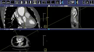 How to read an acute aorta protocol CT