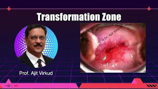 Tranformation Zone Masterclass