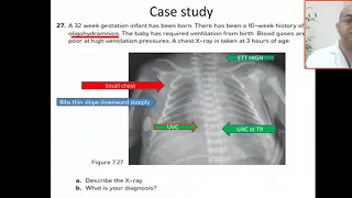 Case 107 lung hypoplasia, oligohydramnios sequence, potter syndrome