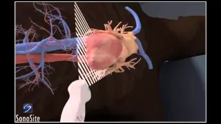 How To: Apical 4-Chamber View, Echocardiography 3D Video