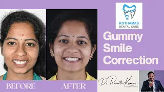 Gummy Smile Correction With Braces - Dr.Praneeth Kumar