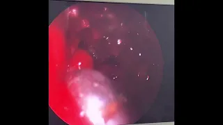 Sphenoidal fungal sinusitis removal