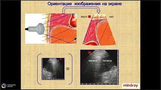 Методические основы УЗИ грудной клетки : УЗД плевральных выпотов и патологии плевры