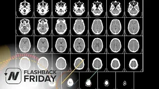 Flashback Friday: Preventing Brain Loss with B Vitamins?