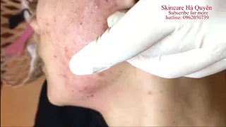 Blackheads and Acne treatment in Ha Quyen Spa on 29/10/2019 part 4 - Điều trị mụn tại Hà Quyên Spa