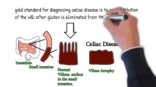 Celiac Disease and gluten intolerance - Symptoms, causes, treatment
