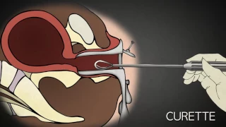 1st Trimester Surgical Abortion Aspiration Suction D & C