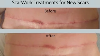 Breast Cancer Scar Therapy Using ScarWork and Scar Massage