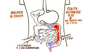 Maladie Inflammatoire de L'intestin (MII)