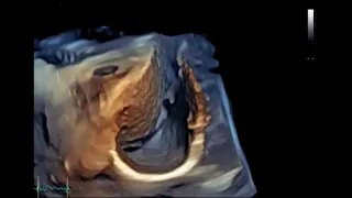 Pericardial cyst