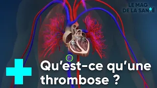 La thrombose veineuse - Le Magazine de la Santé