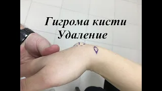 Удаление гигромы кисти