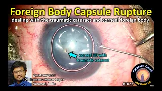 CataractCoach 1023: corneal foreign body and capsule rupture