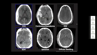 Medical Student Lecture Series: Neurotrauma with Zachary L. Hickman, MD